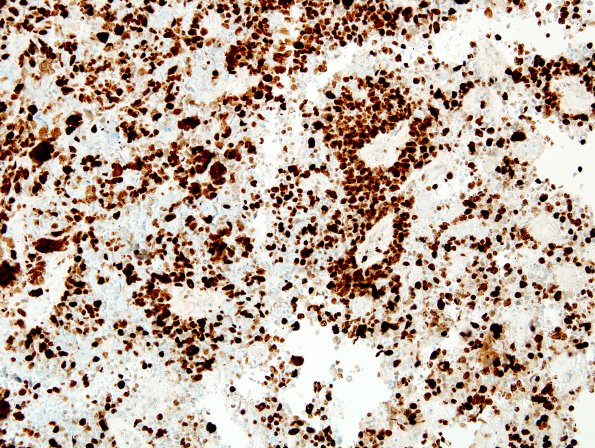 6D ETANTR, medulloepithelioma (Case 6) Ki67 1.jpg