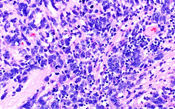 7A3 ETMR (Case 7) H&E 9