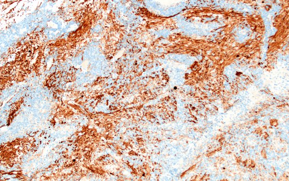 7D2 ETMR (Case 7) NF 2