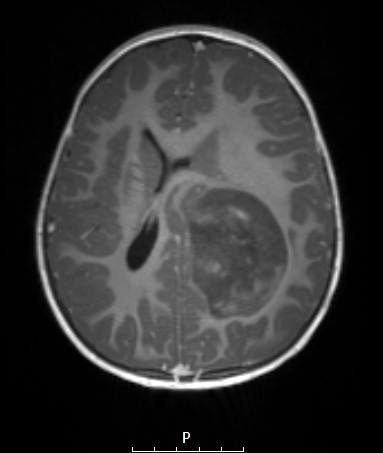 8A2 ETMR (Case 8) T1W - Copy