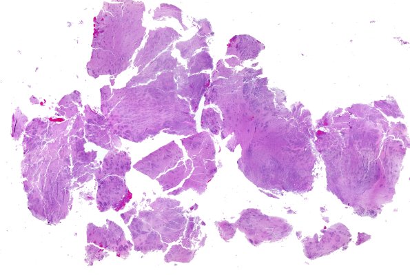 8B1 ETMR (Case 8) H&E B1 WM