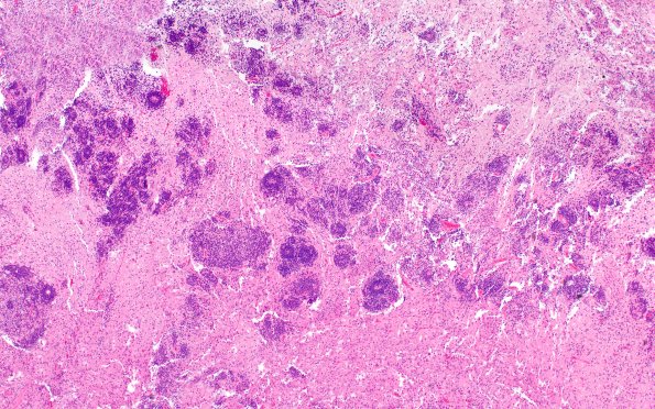 8B2 ETMR (Case 8) B3 H&E 4X 2A