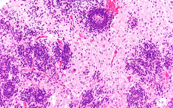 8B3 ETMR (Case 8) B3 H&E 20X