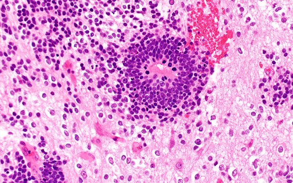 8B4 ETMR (Case 8) B3 H&E 40X 2