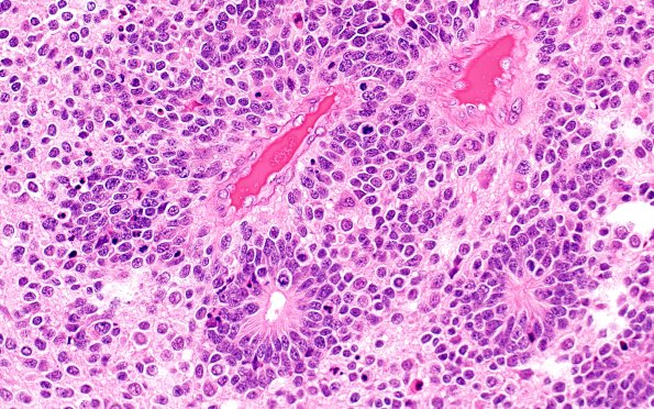 8B5 ETMR (Case 8) B1 H&E 40X 1