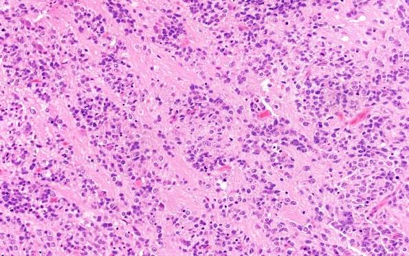 8B6 ETMR (Case 8) B3 H&E 20X 3