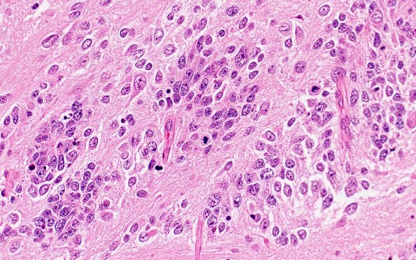 8B7 ETMR (Case 8) B1 H&E 40X 2