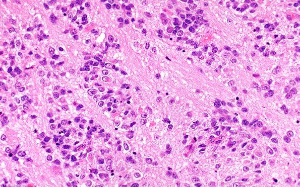 8B8 ETMR (Case 8) B3 H&E 40X 1