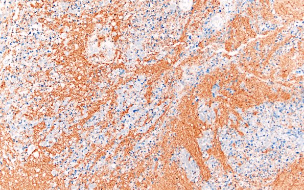 8C2 ETMR (Case 8) B1 SYN 20X 2