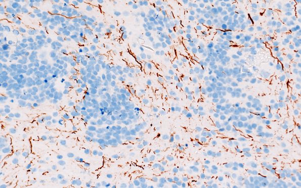 8D5 ETMR (Case 8) B1 NF 40X 5