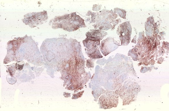 8E1 ETMR (Case 8) GFAP B1 WM