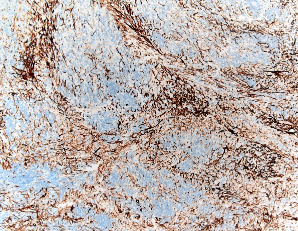 8E2 ETMR (Case 8) B1 GFAP 10X 2