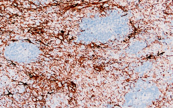 8E4 ETMR (Case 8) B1 GFAP 20X