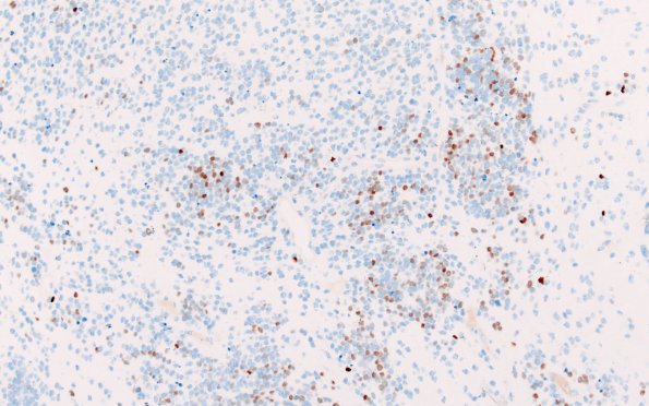 8F1 ETMR (Case 8) B1 Olig2 20X 3