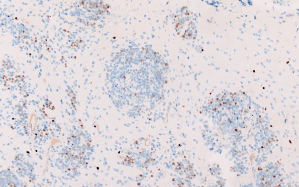 8F2 ETMR (Case 8) B1 Olig2 20X 2