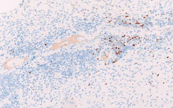 8F3 ETMR (Case 8) B1 Olig2 20X 1