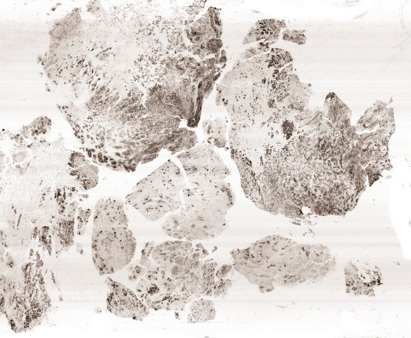 8G1 ETMR (Case 8) Ki67 B1 WM