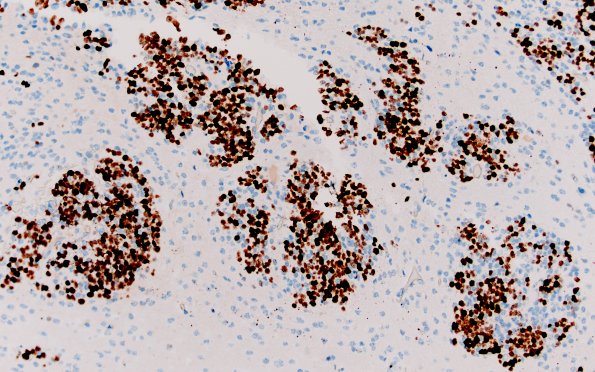 8G3 ETMR (Case 8) B1 Ki67 40X 1