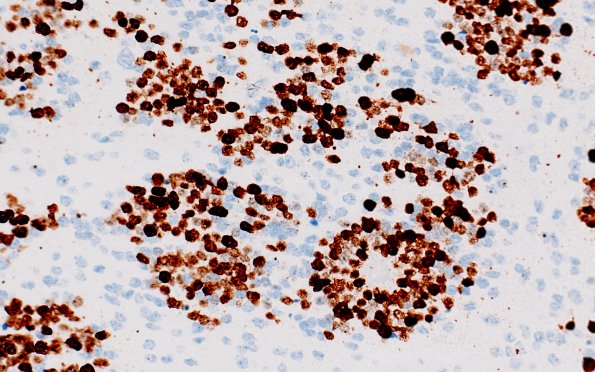 8G4 ETMR (Case 8) B1 Ki67 40X 2