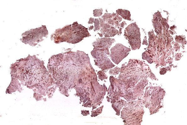 8H1 ETMR (Case 8) VIM B1 WM