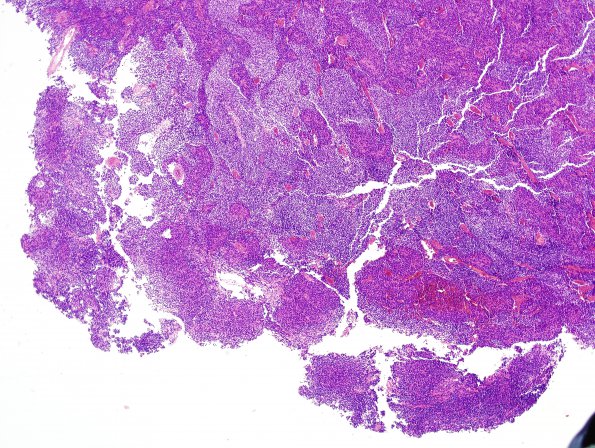 10A1 Medulloblastoma (Case 10) area A H&E 4X