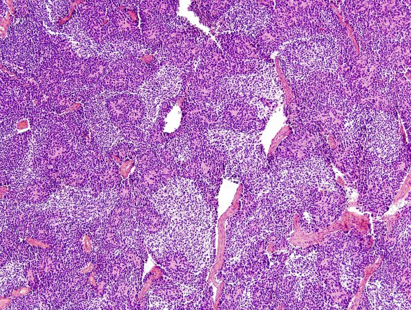 10A2 Medulloblastoma (Case 10) H&E 1