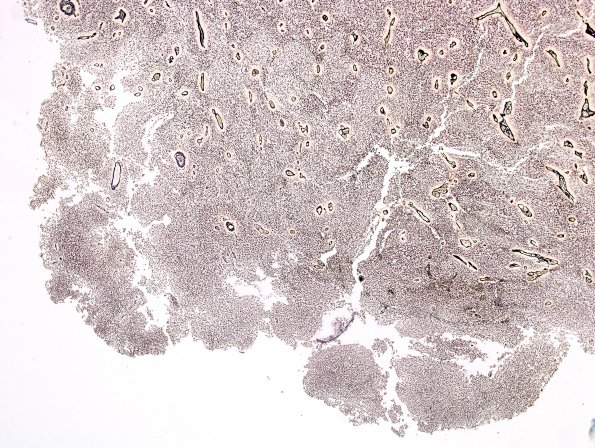 10B1 Medulloblastoma (Case 10) area A Retic 4X