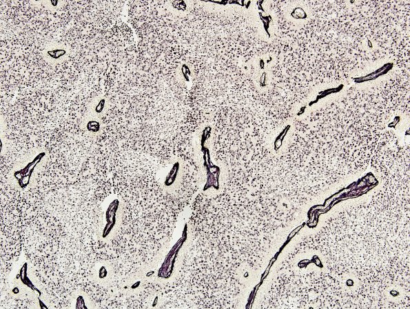 10B2 Medulloblastoma (Case 10) Retic 2