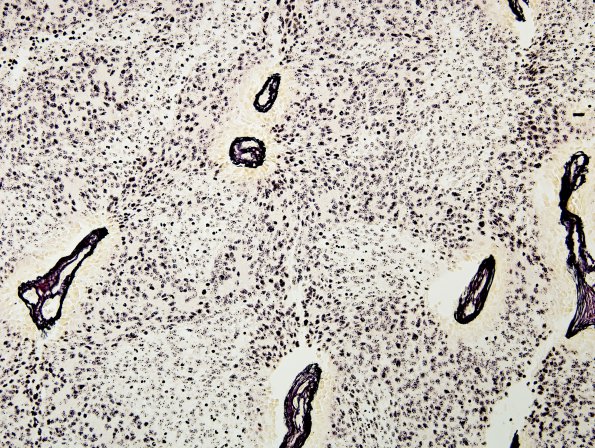 10B3 Medulloblastoma (Case 10) Retic 1