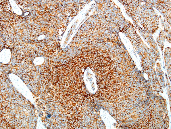 10C2 Medulloblastoma (Case 10) B-catenin 12