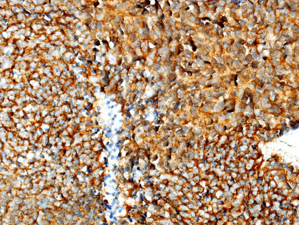 10C3 Medulloblastoma (Case 10) b-catenin 3