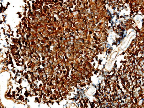 10C4 Medulloblastoma (Case 10) b-catenin 9