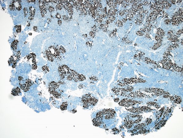 10D1 Medulloblastoma (Case 10) area A MIB 4X