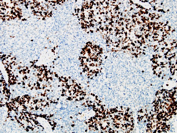 10D 2Medulloblastoma (Case 10) MIB 1