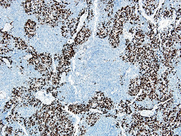 10D3 Medulloblastoma (Case 10) MIB 2