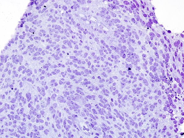 11A1 Medulloblastoma (Case 11) Plastic 5