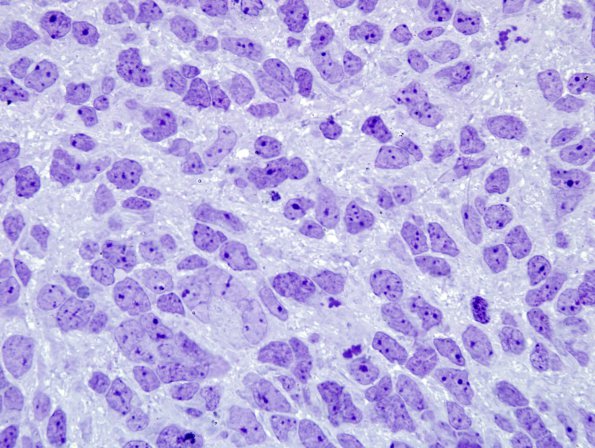 11A2 Medulloblastoma (Case 11) Plastic 3