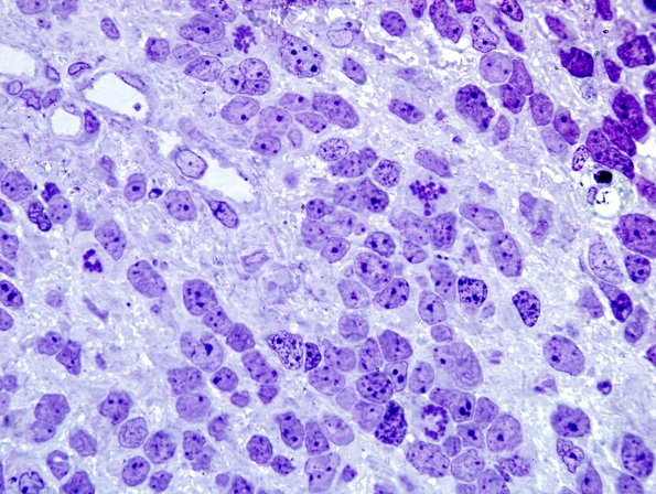 11A3 Medulloblastoma (Case 11) Plastic 2