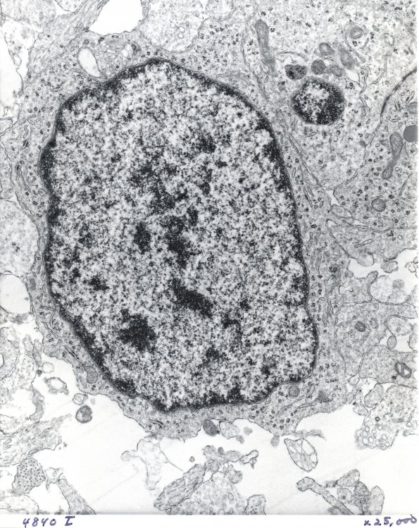 11B1 Medulloblastoma (Case 11) EM 2 - Copy