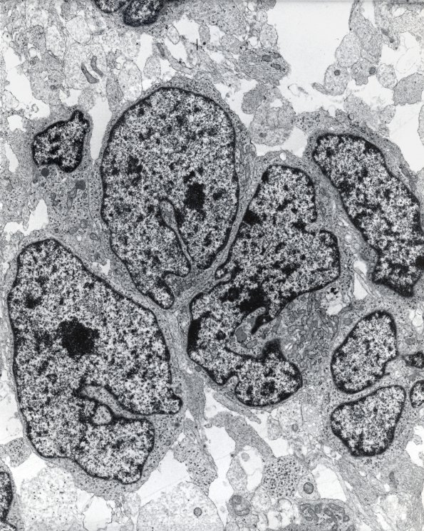 11B2 Medulloblastoma (Case 11) EM 3 - Copy