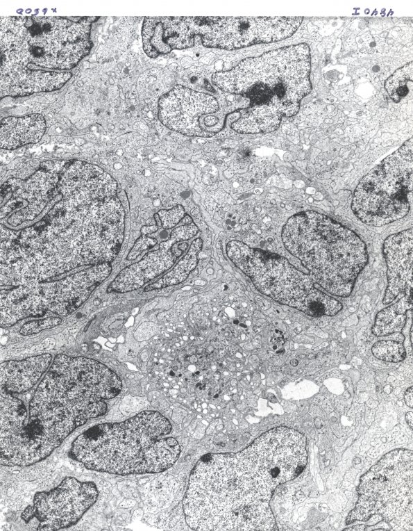 11B3 Medulloblastoma (Case 11) EM 1 - Copy