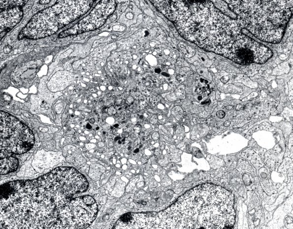 11B4 Medulloblastoma (Case 11) EM 4 - Copy