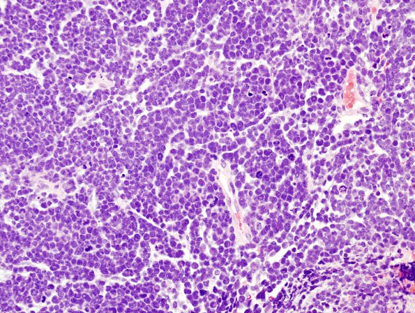 12A1 Medulloblastoma (Case 12) H&E 2