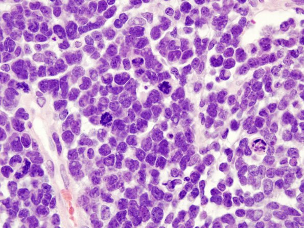 12A2 Medulloblastoma (Case 12) H&E 1