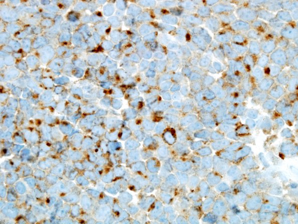 12B Medulloblastoma (Case 12) SYN 1