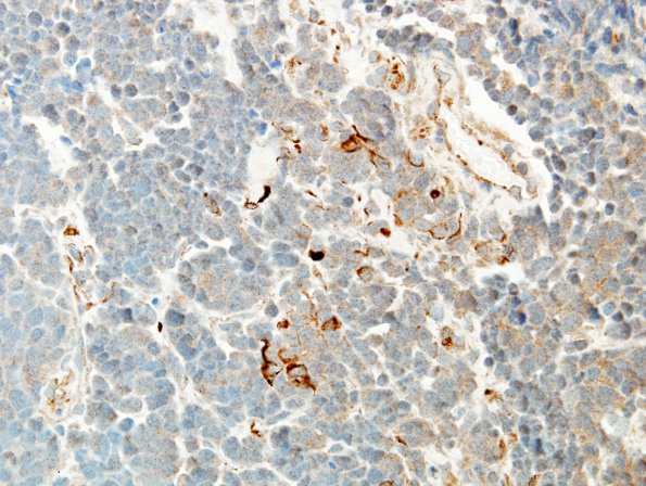 12C Medulloblastoma (Case 12) GFAP