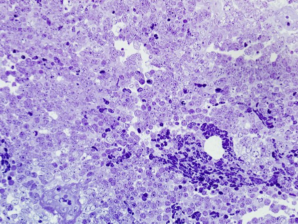 13A Medulloblastoma (Case 13A) Plastic 1