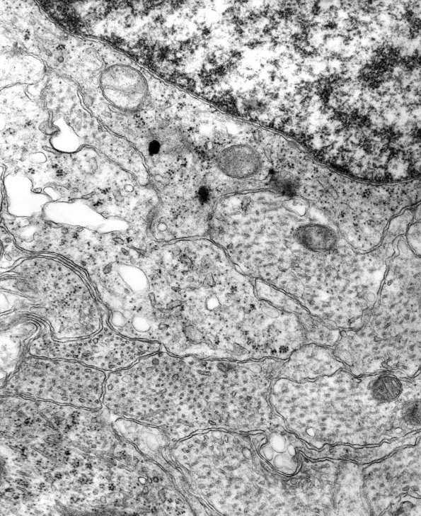 13B1 Medulloblastoma (Case 13B) EM 1 - Copy