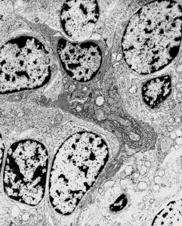 13B3 Medulloblastoma (Case 13B) EM 3 - Copy