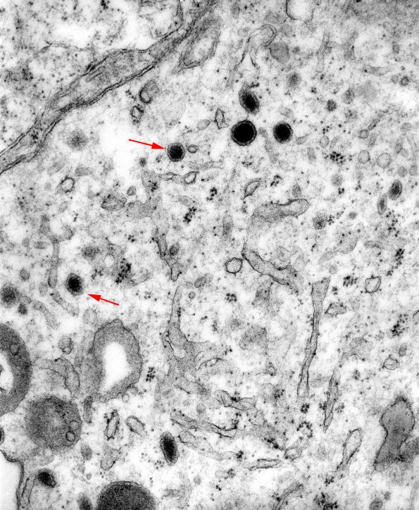 13B4 Medullo (Case 13B) EM 2 copy - Copy - Copy